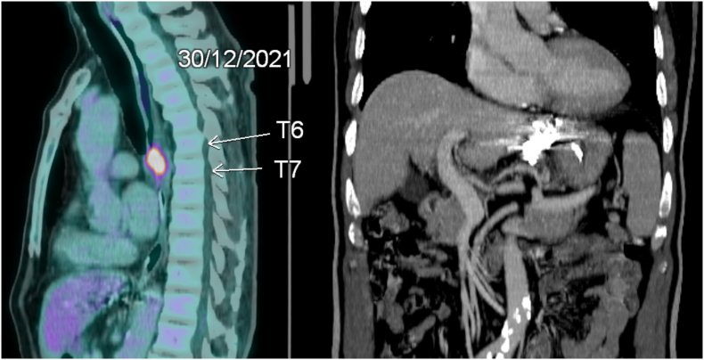 Percutaneous closure of gastrorenal shunt as adjunctive therapy for esophageal carcinoma