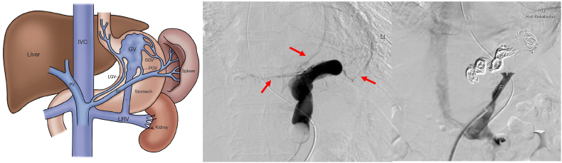 Percutaneous closure of gastrorenal shunt as adjunctive therapy for esophageal carcinoma