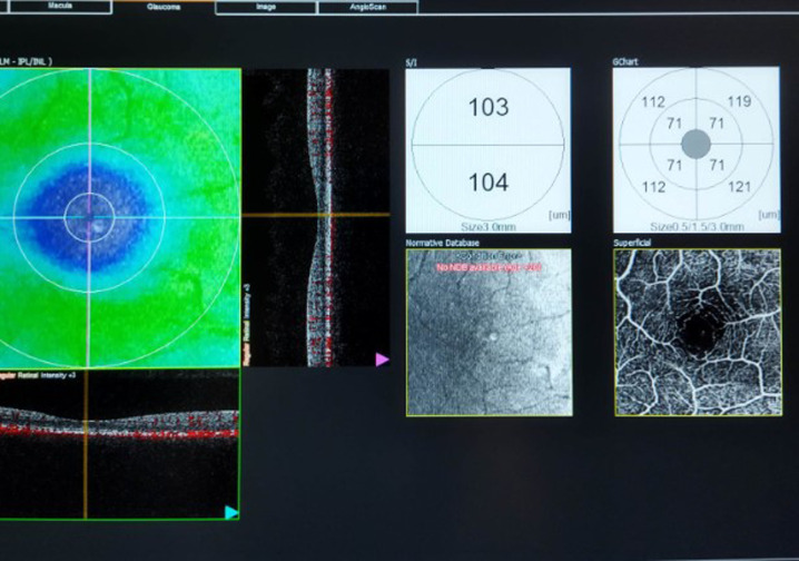 Comparison of Retinal Microvascular Vascular Density Between Adolescents With and Without Simple Myopia Using Optical Coherence Tomography Angiography.