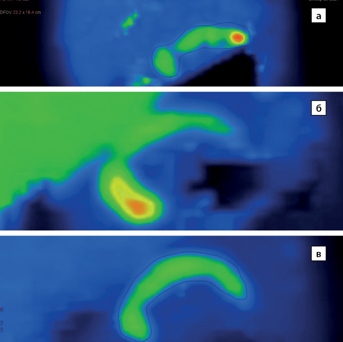 [Electroencephalogram features in children with congenital hyperinsulinism treated according to the international protocol in Russian Federation].