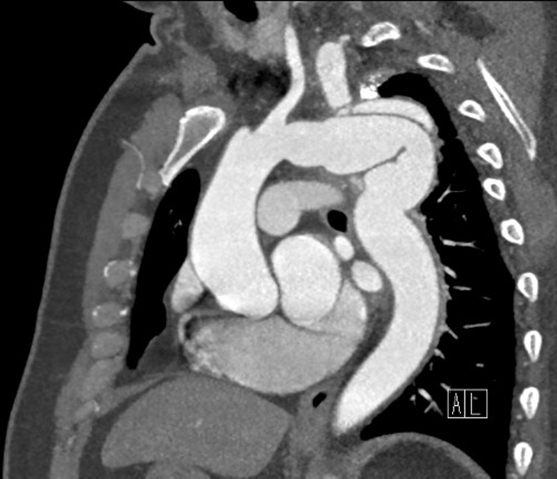 Repair of a Late Presentation Thoracic Aortic Aneurysm following Coarctation Repair.