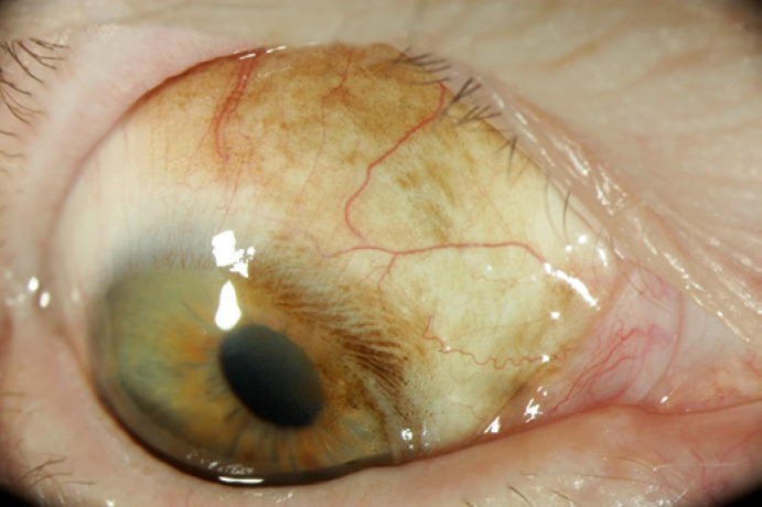 Recurrence of Primary Acquired Melanosis and Conjunctival Intraepithelial Neoplasia.