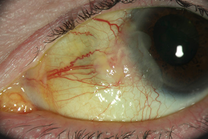 Recurrence of Primary Acquired Melanosis and Conjunctival Intraepithelial Neoplasia.