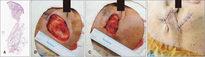 Partial Purse String Suture with Delayed Reconstruction for a Large Defect Abutting a Free Margin.