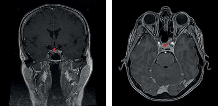 [Cyclic Cushing's syndrome: difficulties of diagnostic search and choice of treatment tactics. A clinical case].