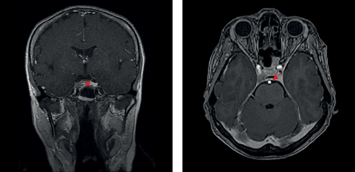 [Cyclic Cushing's syndrome: difficulties of diagnostic search and choice of treatment tactics. A clinical case].