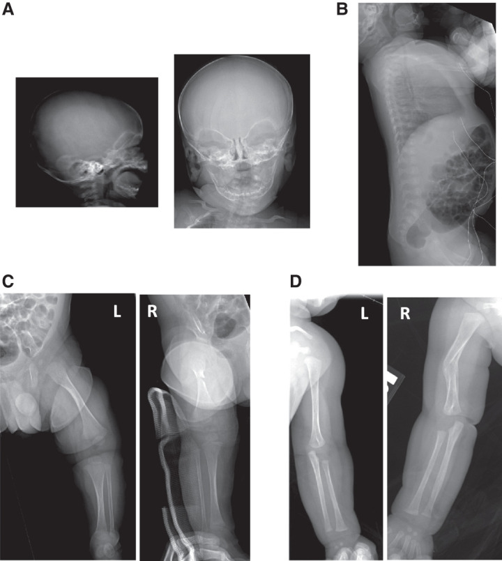 Milder presentation of osteogenesis imperfecta type VIII due to compound heterozygosity for a predicted loss-of-function variant and novel missense variant in <i>P3H1</i>-further expansion of the phenotypic spectrum.