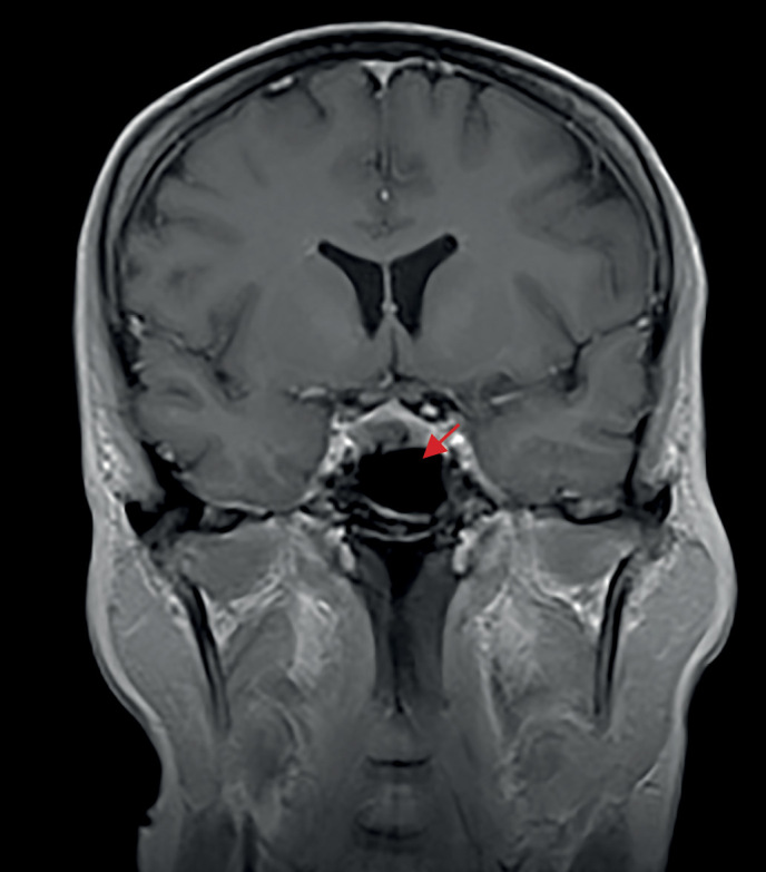 [Cyclic Cushing's syndrome: difficulties of diagnostic search and choice of treatment tactics. A clinical case].