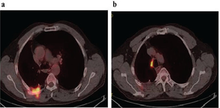 Oxidized Regenerated Cellulose can be a Cause of False Tumor Recurrence on PET/CT in Patients with Lung Cancer Treated Surgically.