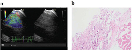 Oxidized Regenerated Cellulose can be a Cause of False Tumor Recurrence on PET/CT in Patients with Lung Cancer Treated Surgically.