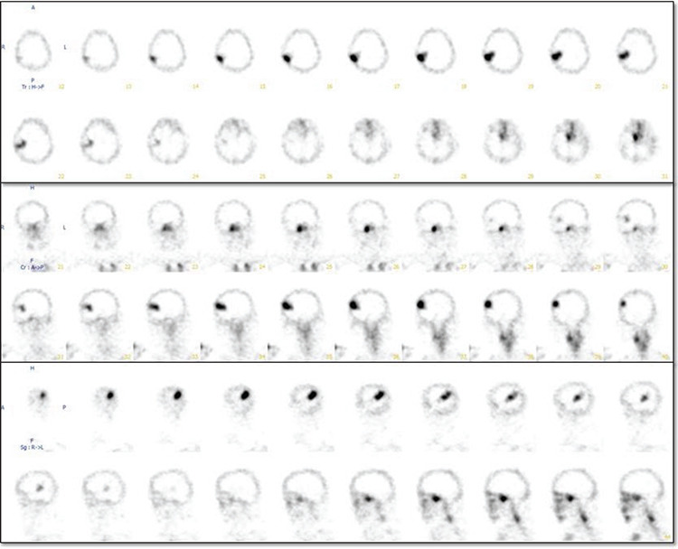 Incidental Tc-99m MDP Uptake in Cortical-subcortical Parietotemporal Cerebral Area in a Patient with a History of Recent Ischemic Cerebrovascular Event who Underwent Whole-body Bone Scan.