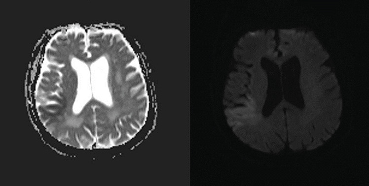 Incidental Tc-99m MDP Uptake in Cortical-subcortical Parietotemporal Cerebral Area in a Patient with a History of Recent Ischemic Cerebrovascular Event who Underwent Whole-body Bone Scan.