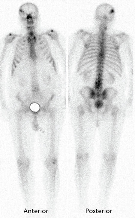 Incidental Tc-99m MDP Uptake in Cortical-subcortical Parietotemporal Cerebral Area in a Patient with a History of Recent Ischemic Cerebrovascular Event who Underwent Whole-body Bone Scan.