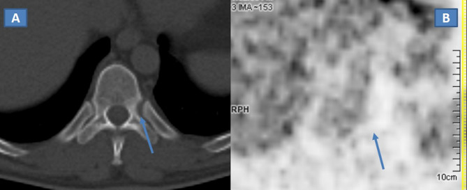 Langerhans cell histiocytosis: unusual dorsal spine localization in an adult male.