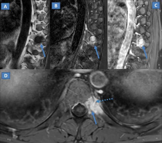 Langerhans cell histiocytosis: unusual dorsal spine localization in an adult male.