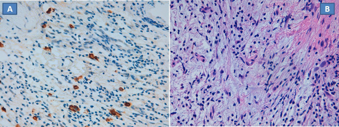 Langerhans cell histiocytosis: unusual dorsal spine localization in an adult male.