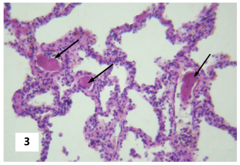 Shock-Associated Systemic Inflammation in Amniotic Fluid Embolism, Complicated by Clinical Death.