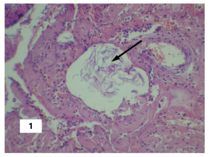 Shock-Associated Systemic Inflammation in Amniotic Fluid Embolism, Complicated by Clinical Death.