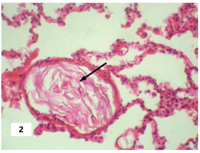 Shock-Associated Systemic Inflammation in Amniotic Fluid Embolism, Complicated by Clinical Death.