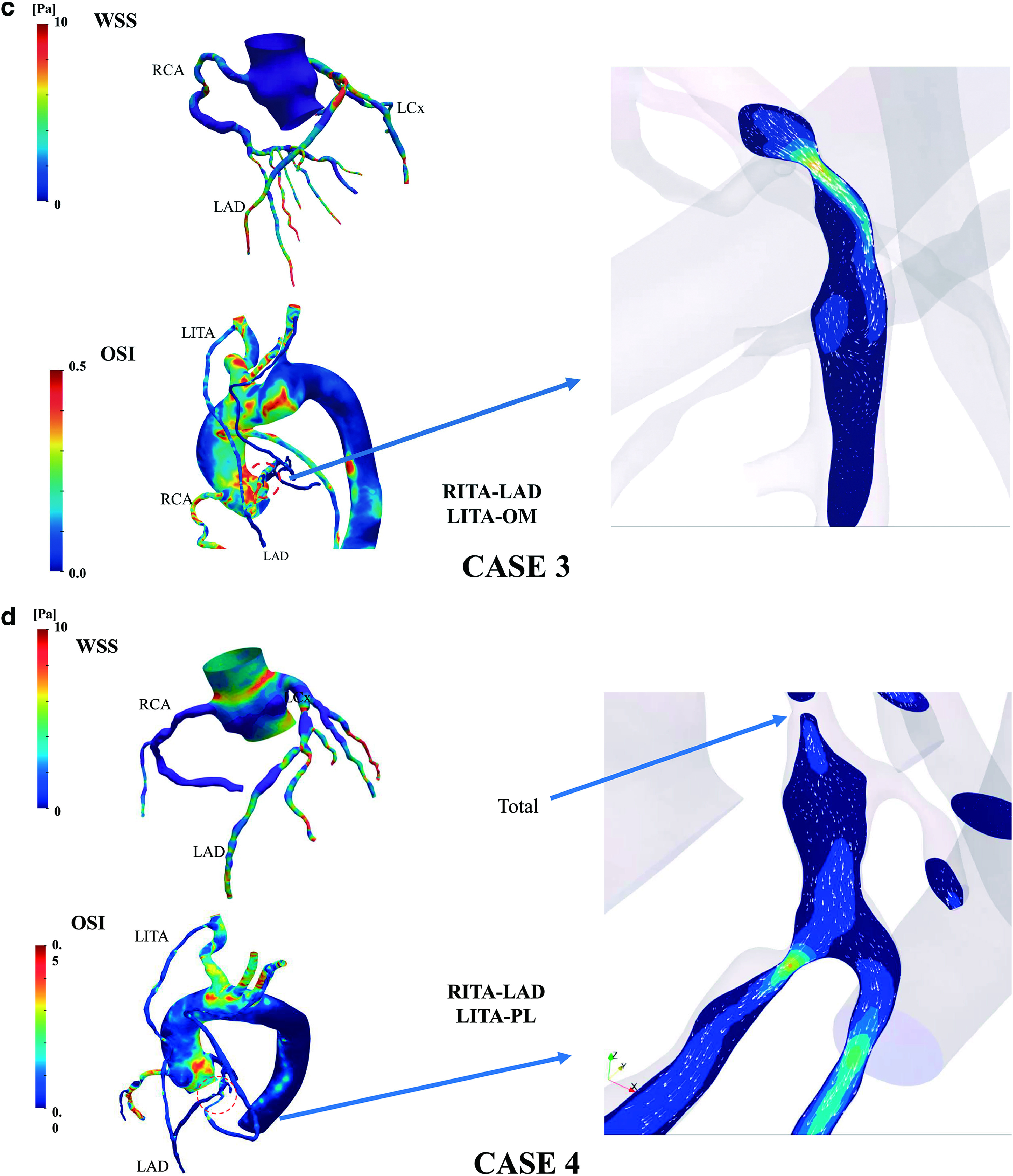 Changes in Internal Thoracic Artery Blood Flow According to the Degree of Stenosis of the Anterior Descending Branch of the Left Coronary Artery.