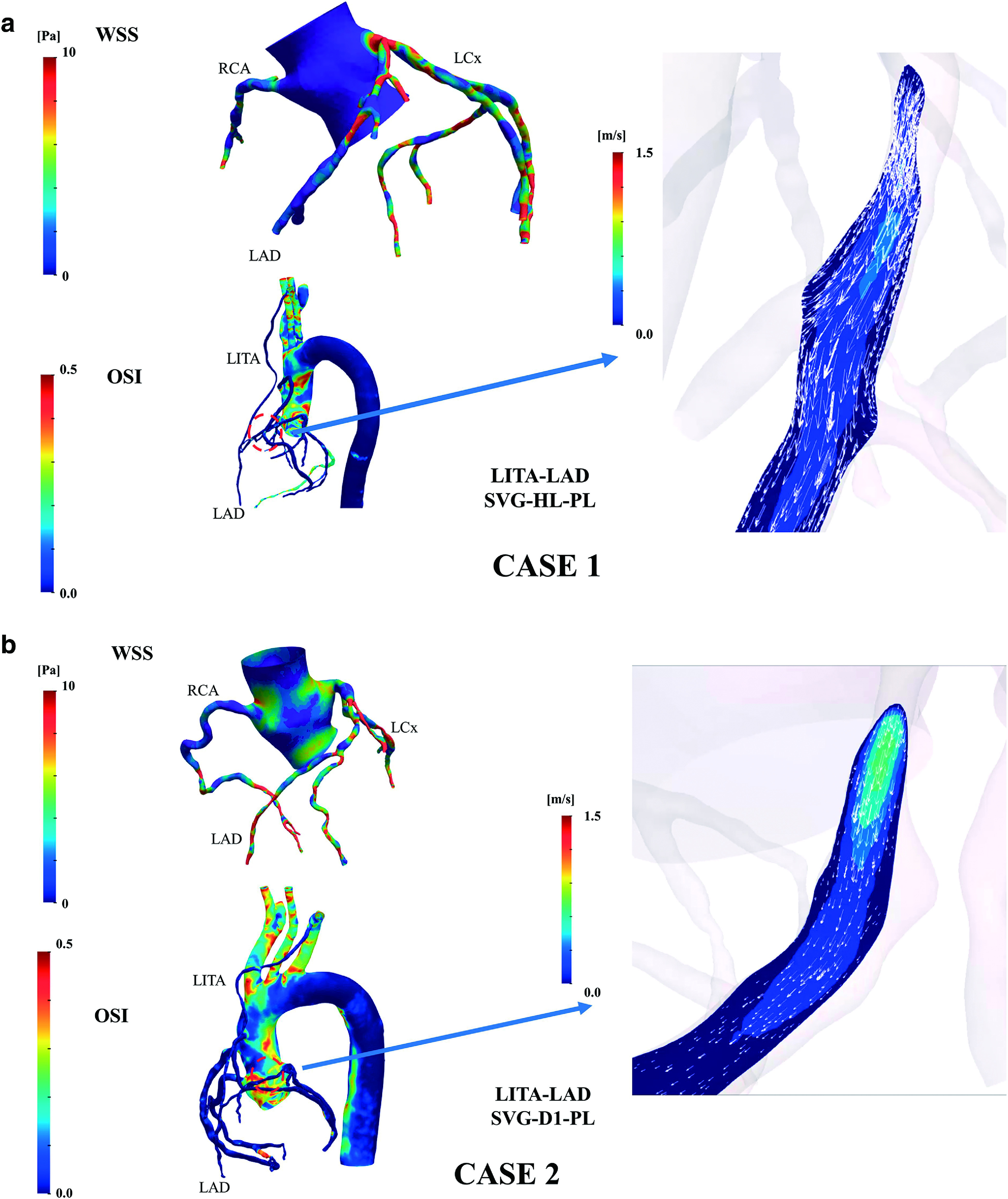 Changes in Internal Thoracic Artery Blood Flow According to the Degree of Stenosis of the Anterior Descending Branch of the Left Coronary Artery.