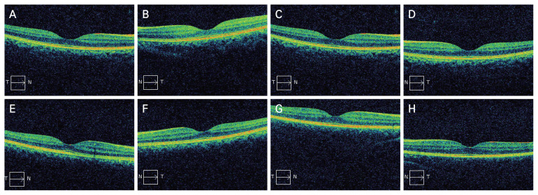 Evaluation of Visual Acuity, Macular Thickness, and Level of Proteinuria in Children with Nephrotic Syndrome.