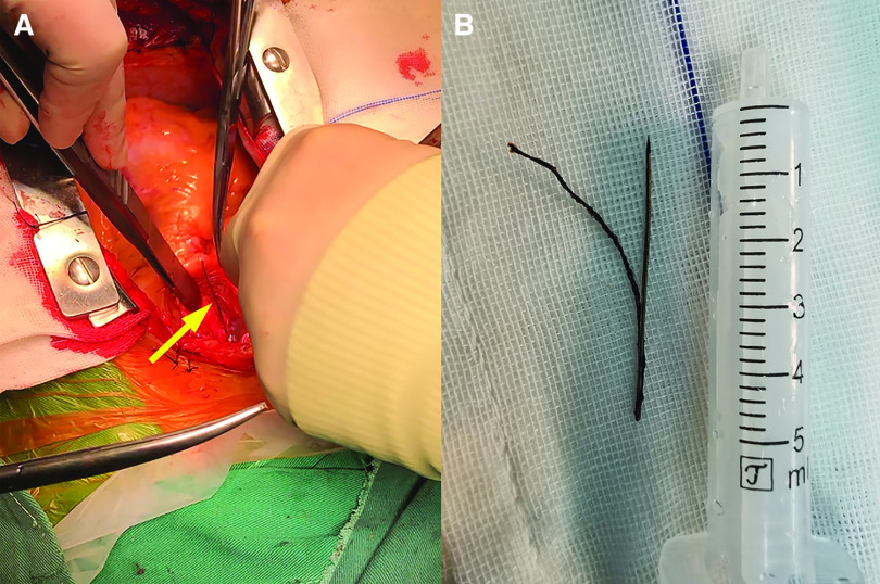 Inadvertently Swallowed Needle Pierced the Pulmonary Artery in an Adult.