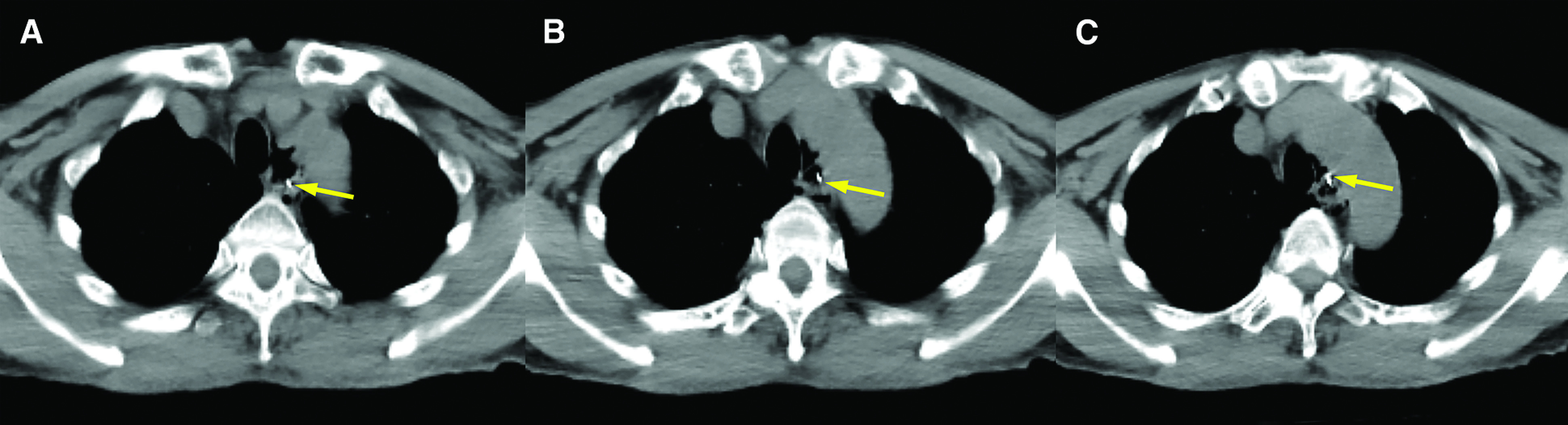 Inadvertently Swallowed Needle Pierced the Pulmonary Artery in an Adult.