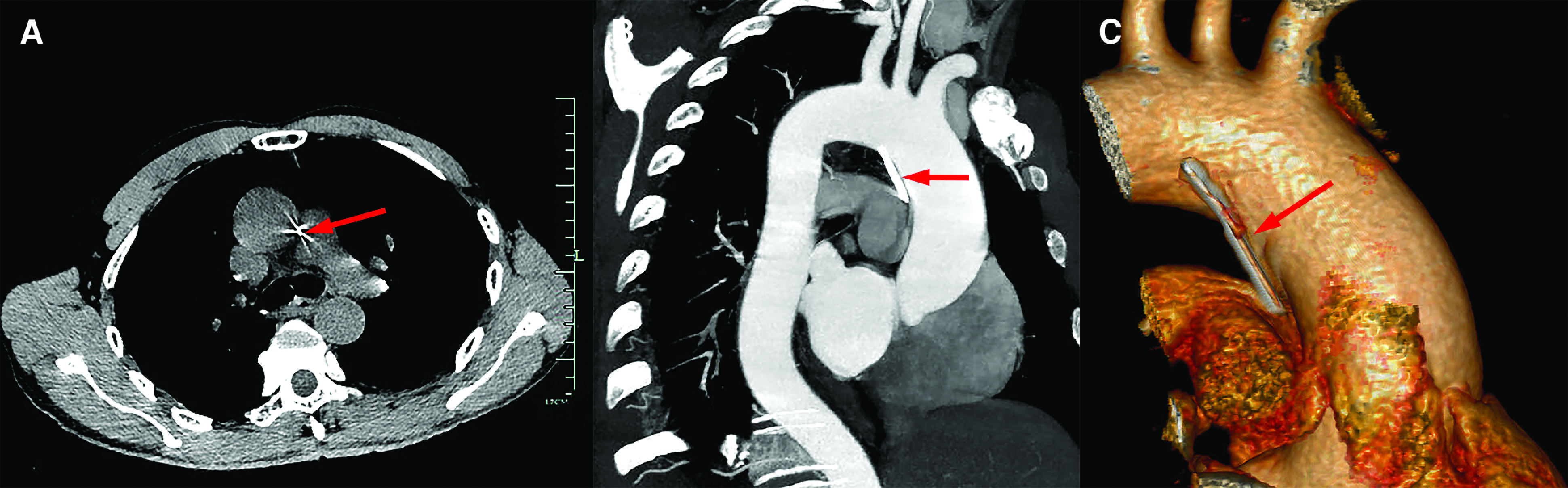 Inadvertently Swallowed Needle Pierced the Pulmonary Artery in an Adult.