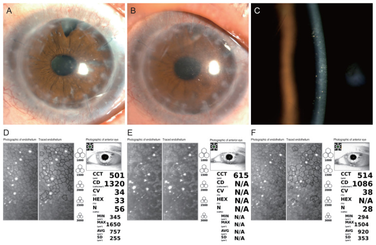 Corneal Graft Rejection after Vaccination against COVID-19: A Case Report.