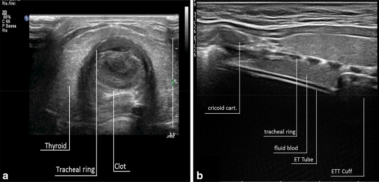 Point-of-care airway US: a valuable tool in the management of occult over the cuff bleeding and secretions.