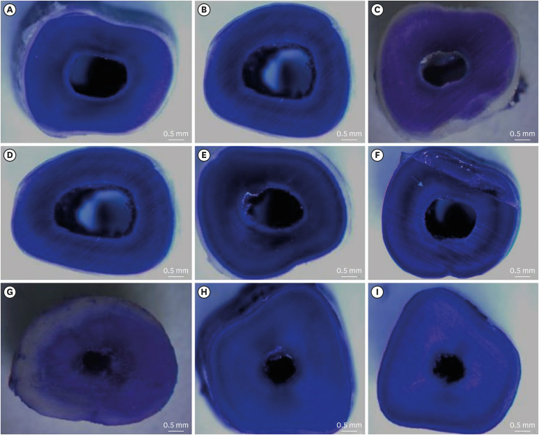 Dentinal tubule penetration of sodium hypochlorite in root canals with and without mechanical preparation and different irrigant activation methods.