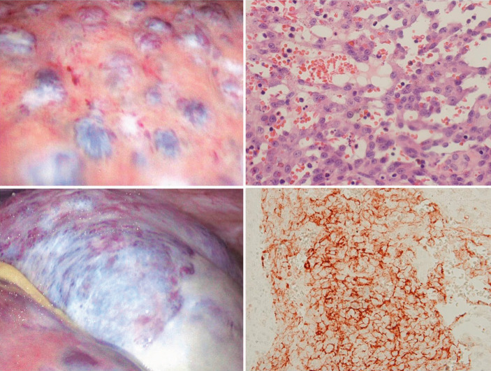 Images in Immunotherapy and Precision Oncology: Angiosarcoma of the Spleen and Liver.