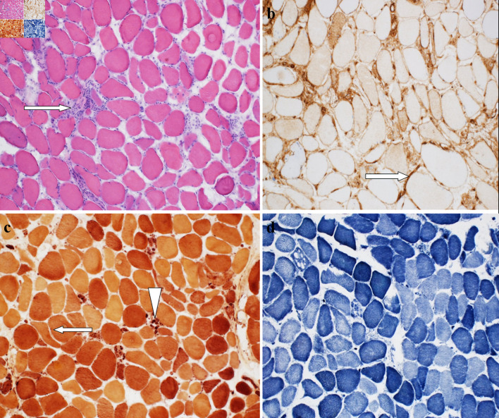 Statin-Induced Immune-Mediated Necrotizing Myopathy Resulting in Proximal Muscle Weakness.