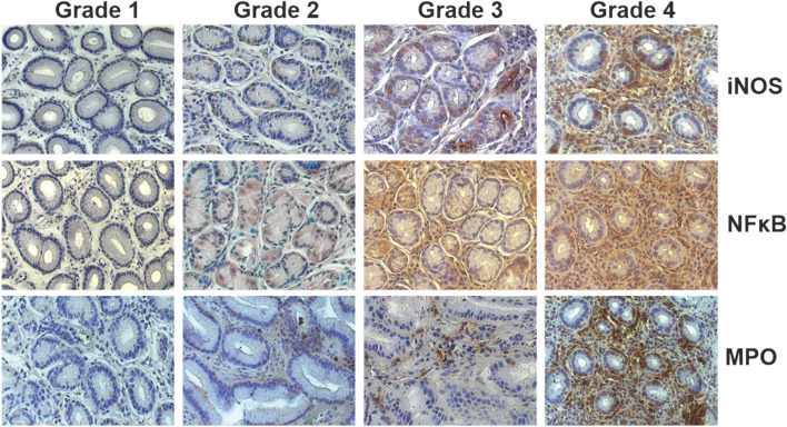 Association between self-rated depressive symptoms and mucosal expression of NF-κ B in patients with upper gastrointestinal symptoms.