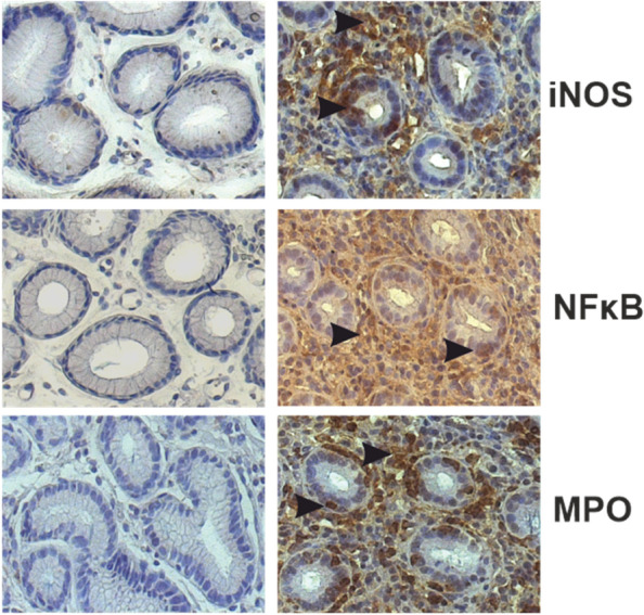 Association between self-rated depressive symptoms and mucosal expression of NF-κ B in patients with upper gastrointestinal symptoms.