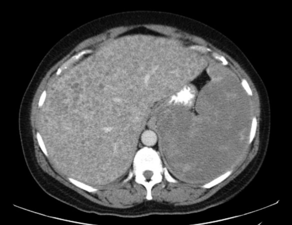 Images in Immunotherapy and Precision Oncology: Angiosarcoma of the Spleen and Liver.