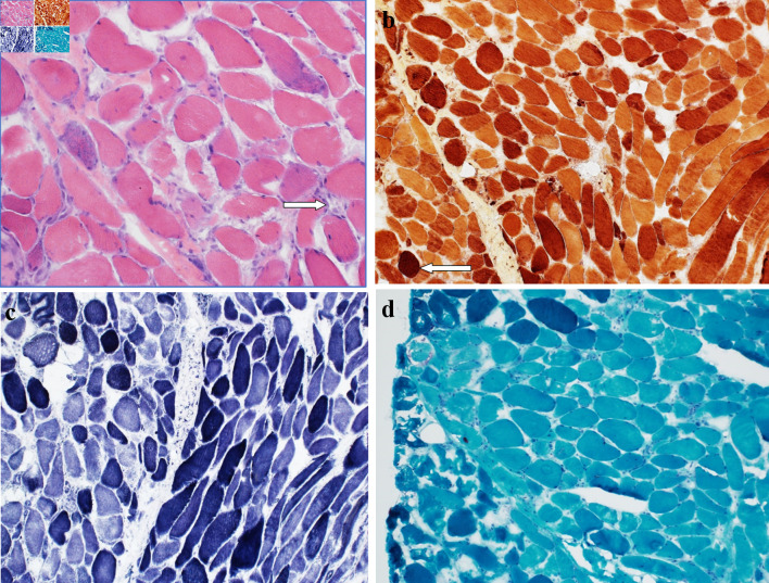 Statin-Induced Immune-Mediated Necrotizing Myopathy Resulting in Proximal Muscle Weakness.