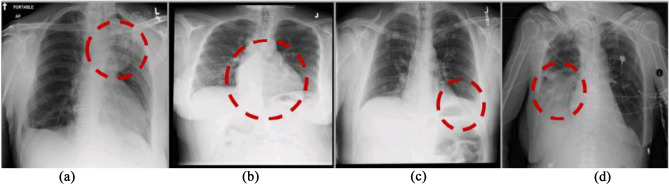 Localization of lung abnormalities on chest X-rays using self-supervised equivariant attention.