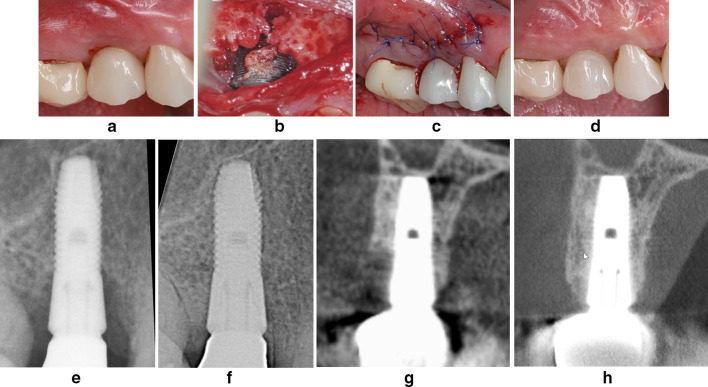 Hard and soft tissue regeneration of severe peri-implantitis defects with the laser-assisted peri-implant defect regeneration technique: 3-year results.