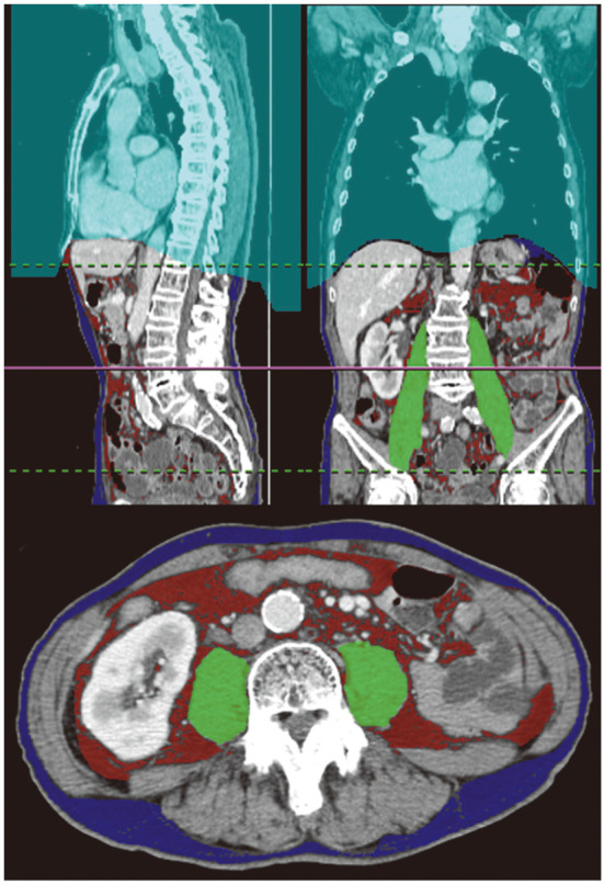 The Kagoshima-DVT Score Is a Useful Predictive Model for Cancer-Associated Thrombosis in Patients With Gastrointestinal Cancer.