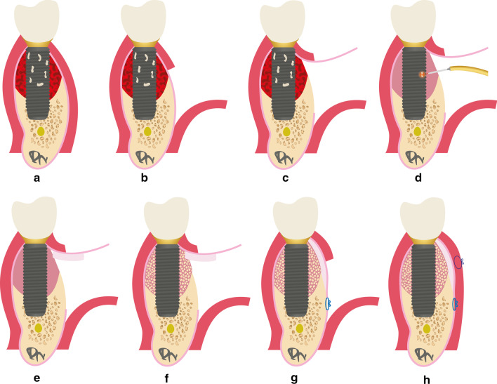 Hard and soft tissue regeneration of severe peri-implantitis defects with the laser-assisted peri-implant defect regeneration technique: 3-year results.