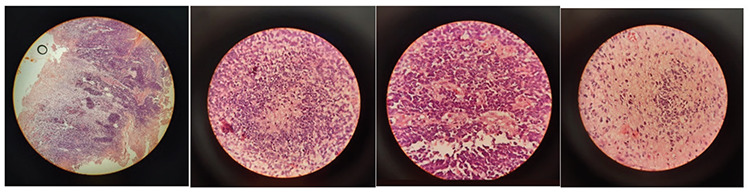 Metachronous Brain Tumor in 177Lu-PSMA Scan in a Patient with Metastatic Castration Resistant Prostate Cancer Mimicking Disease Progression.