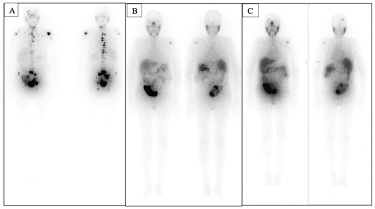 Metachronous Brain Tumor in 177Lu-PSMA Scan in a Patient with Metastatic Castration Resistant Prostate Cancer Mimicking Disease Progression.