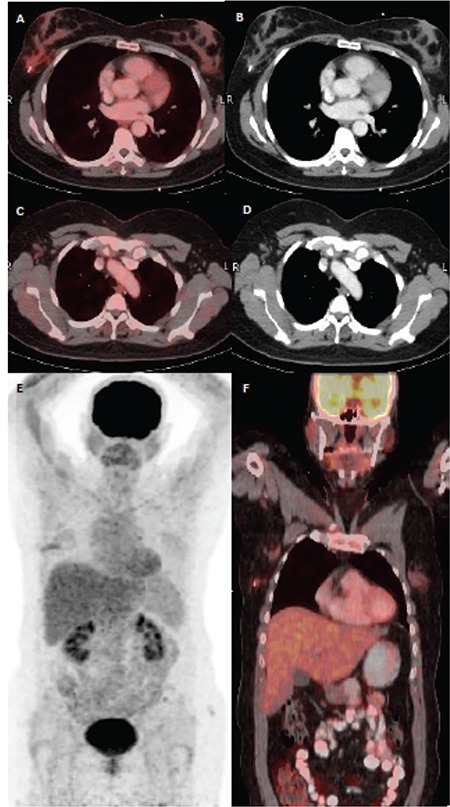 Primary Isolated Breast Lymphoma Presenting as Primary Breast Cancer with <sup>18</sup>F-FDG PET/CT.