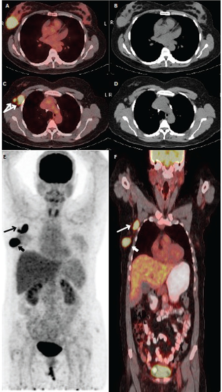 Primary Isolated Breast Lymphoma Presenting as Primary Breast Cancer with <sup>18</sup>F-FDG PET/CT.