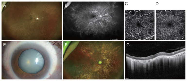 Radiation Retinopathy after Heavy Ion Particle Therapy for Maxillary Sinus Cancer: A Case Report.