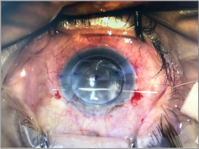 Incidence, Pathophysiology, Complications, and Management of Positive Vitreous Pressure During Penetrating Keratoplasty: A Literature Review.