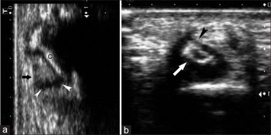 Nora Lesion (Bizarre Parosteal Osteochondromatous Proliferation): An Ultrasound Diagnosis with Magnetic Resonance Imaging Correlation.