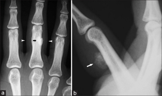 Nora Lesion (Bizarre Parosteal Osteochondromatous Proliferation): An Ultrasound Diagnosis with Magnetic Resonance Imaging Correlation.